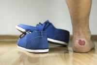 Definition and Causes of Foot Blisters