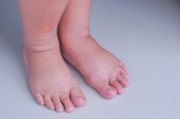 Causes of Swollen Feet and Ankles